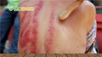 Guasha, photo from healthnews.com.tw