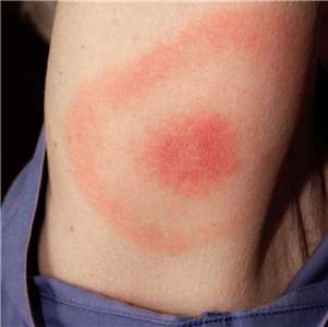 捷克醫療機構今年第一季度已通報超過1300例由蜱蟲傳播的萊姆病病例。圖為萊姆病引起的紅斑斑疹。(圖：維基百科)