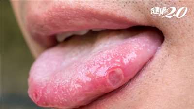 ระวัง!! ฟันปลอมไม่พอดีช่องปาก กลายเป็นต้นเหตุมะเร็งลิ้น (Cr. health.tvbs.com.tw)