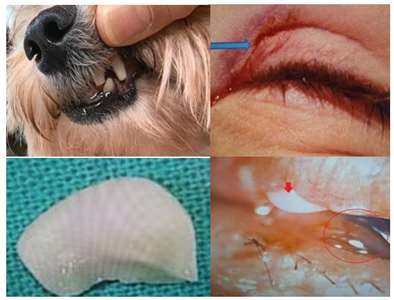 อุทาหรณ์เตือนใจ มอลทีสกัดหญิงคนหนึ่ง เฉียดกระจกตา 0.01 ซม. เกือบตาบอด(photo Dr.Yang Laser Alliance)