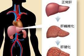 พัฒนาการของโรคตับ (จากบนสู่ล่าง) แรกสุดที่ตับยังปกติ สู่เริ่มเกิดพังผืดและกลายเป็นโรคตับแข็ง  (ภาพจาก liver.org.tw)