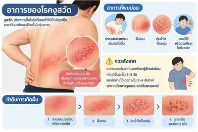 โรคงูสวัด อันตรายถึงชีวิต จริงหรือ ?